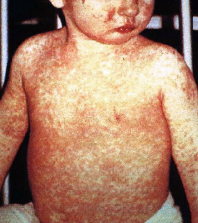 In Svizzera la prima morte per morbillo dopo otto anni