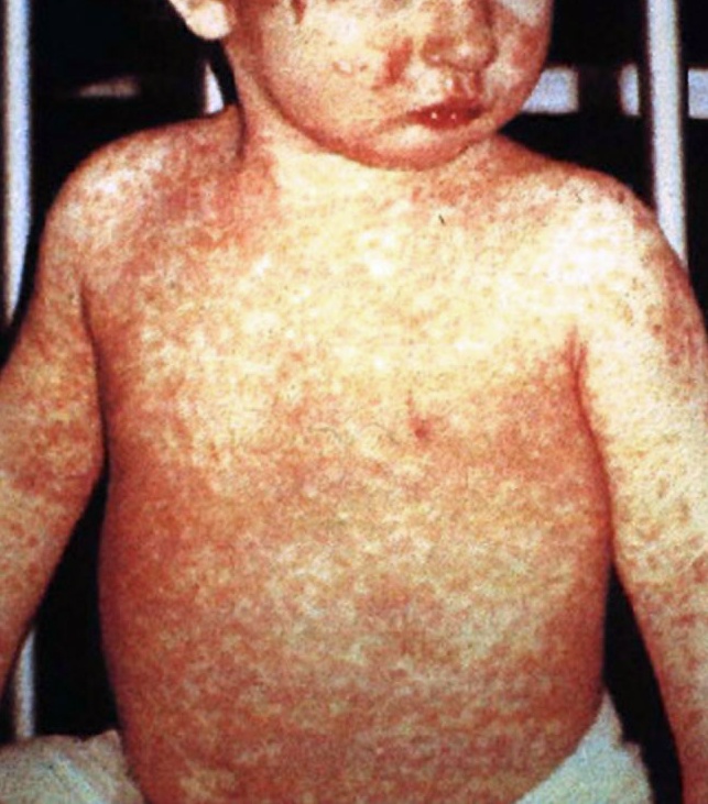 Romania: epidemia di morbillo miete 17 vittime