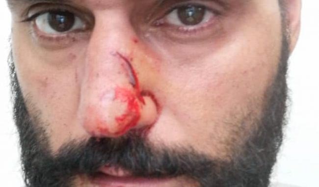 Colpito al volto dallo specchietto dopo l’incidente